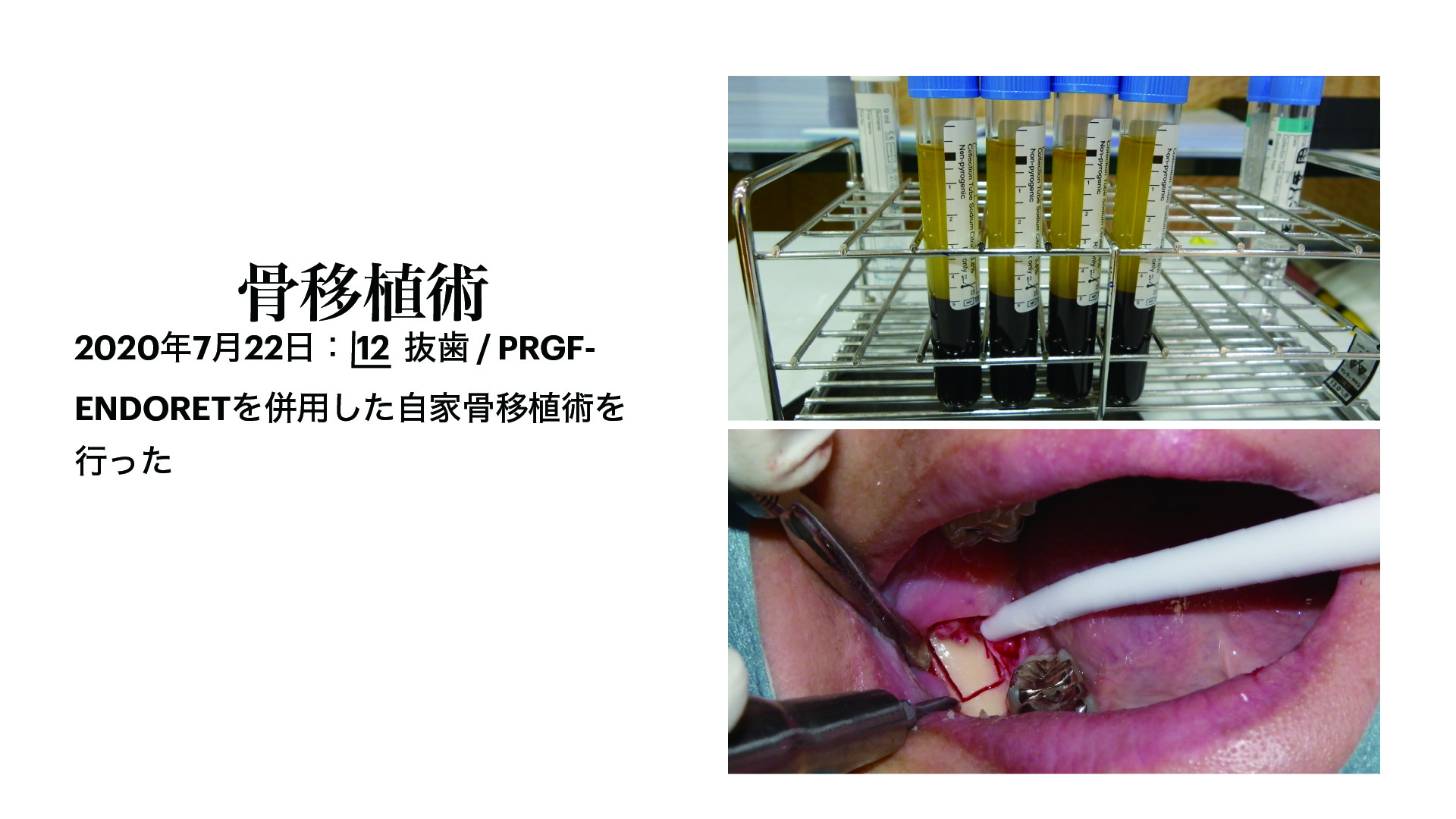 症例 45